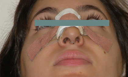 Nose Job - After a week