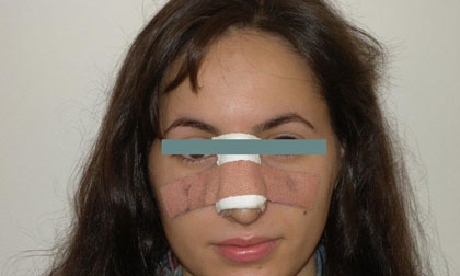 Nose Job